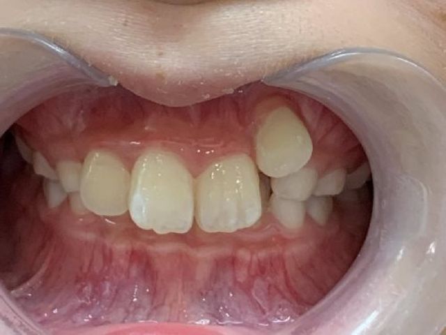 治療前の歯並び